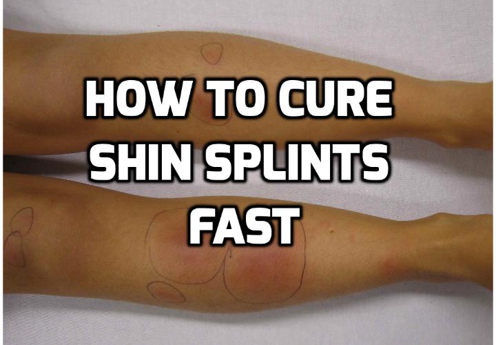 How to Really Best Treat Shin Splints & Get LASTING Relief AntiAging