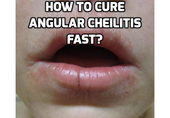 Angular Cheilitis Definition, Causes and Treatment AntiAging