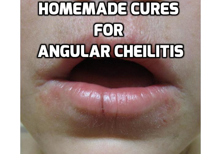 Find Relief for Angular Cheilitis Using These Homemade Solutions Anti