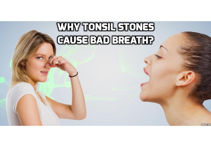 What Causes Tonsil Stones Bad Breath? AntiAging, Beauty, Health