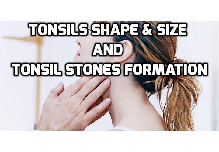 What is the Link between Size and Shape of Tonsils and Tonsil Stones