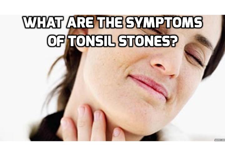 What are the Symptoms of Tonsil Stones? AntiAging, Beauty, Health