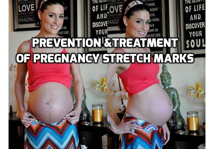 Dermatologists Share Advice On Prevention and Treatment of Stretch Marks During Pregnancy - This post will discuss about what causes stretch marks during pregnancy, how to prevent getting stretch marks during pregnancy, how to treat stretch marks during and after pregnancy, plus video clips on Natural Remedies to Remove Pregnancy Stretch Marks and Preventing Stretch Marks and Too Much Weight During Pregnancy + Post-Partum Weight Loss.
