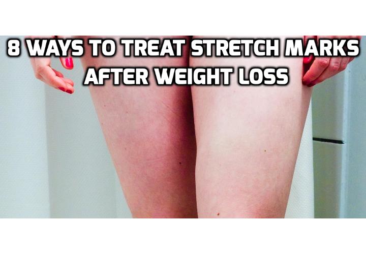 Revealing Here the 8 Best Ways to Treat Stretch Marks After Weight Loss - In this post, I will discuss about how best to treat stretch marks after weight loss. You can find here 8 ways you can consider to treat stretch marks after weight loss and reduce their appearance. You can also watch a video clip here on how to get rid of stretch marks and loose skin after weight loss.