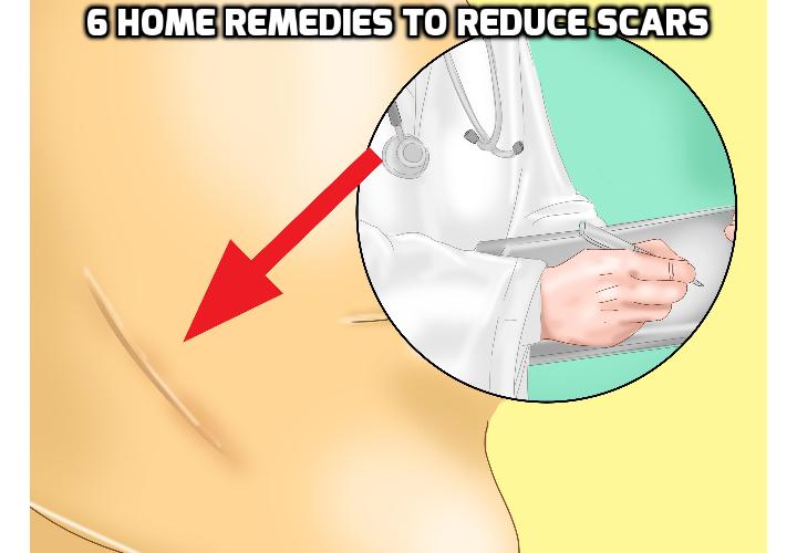 Scar Treatment Home Remedies – How Best to Reduce Scar Visibility? This post will discuss about how do scars form, the different types of scar, the 6 scar treatment home remedies you can use to reduce scar visibility and a video clip on how to get rid of scar spot tissue on face and legs.